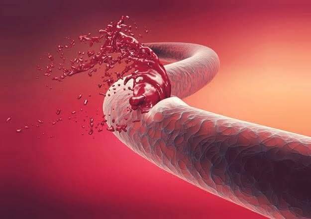 داواکارییەک ئاراستەی پەرلەمانتارانی عێراق دەکرێت؛ هۆشداری دەدرێت لە مەترسیی گیانی سەدان تووشبووی هیمۆفیلیا لە هەرێم